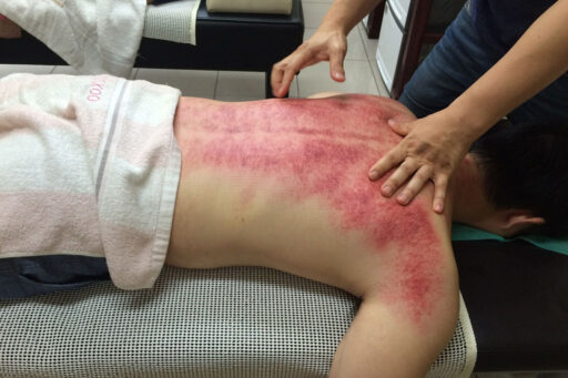 Muscle Scraping Abq & santa Fe